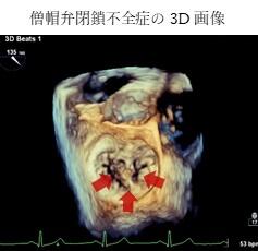 心臓弁膜症_3.jpg